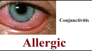 Allergic Conjunctivitis [upl. by Teuton]