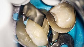 Dentist Filling a Cavity in Baby Teeth Tooth Decay at 16x Magnification [upl. by Kennett888]