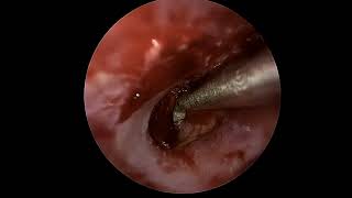 Ear drum repair tympanoplasty with lateral graft [upl. by Enelra]