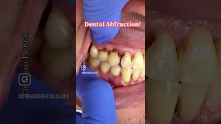 Dental Abfraction [upl. by Leinoto]