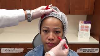 Cheek Augmentation Video  Dr Valaie MD  Newport Beach Orange County OC CA [upl. by Latoye]