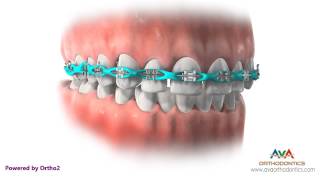 Space Closure by Power Chain  Orthodontic Treatment [upl. by Michal]