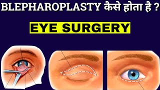 How Blepharoplasty Is Performed  Blepharoplasty  Eyelid Surgery Animation [upl. by Eelyak]