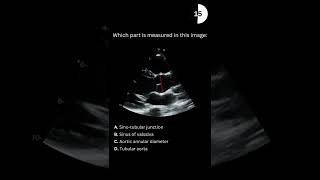 Echocardiography board practice question 30 [upl. by Pacien712]