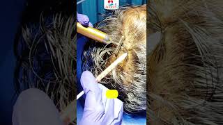 HAIR PRP Treatment for Hair Regrowth Aceasis Aesthetic Solution Live Patient Treatment 9674257567 [upl. by Clercq]