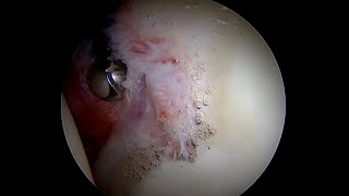 Labral Tear with High Grade Complexity of Tearing Degeneration and Bruising [upl. by Pressman]