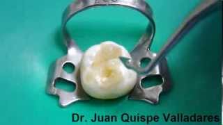 Curación Dental con resina Parte 1  PermaSeal Ultradent [upl. by Anned]