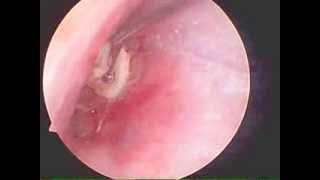 Endoscopic cartilage tympanoplasty [upl. by Anrahc304]