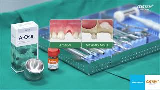 AOSS Osstem Implant bovine xenograft luudutusmateriaali [upl. by Ashlee]