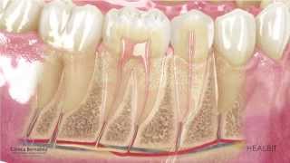 Qué es una endodoncia [upl. by Ecilahs]