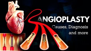 Angioplasty Causes Signs and Symptoms Diagnosis and Treatment [upl. by Ycal]