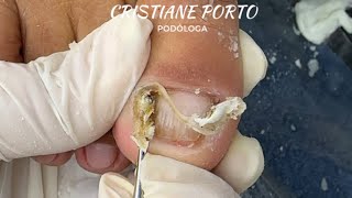 🤤PARTE 2 QUANTA PELE TINHA NESSE DEDO GENTE  satisfatório nails viralvideo peeling [upl. by Tartan209]