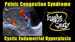 Pelvic Congestion Syndrome amp Endometrial Cystic Hyperplasia  Ultrasound  Doppler  Case 90 [upl. by Mini989]