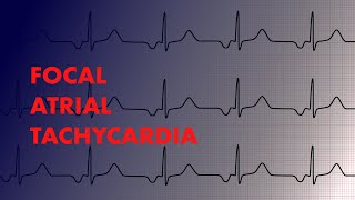 Focal Atrial Tachycardia  EKG Interpretation  MEDZCOOL [upl. by Avrom565]