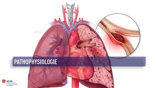 ESC Lungenembolie Leitlinie 2019 Epidemiologie prädisponierende Faktoren Pathophysiologie [upl. by Dusa216]