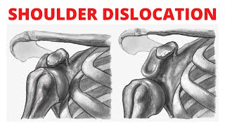 Shoulder Dislocation  Treatment of Dislocation [upl. by Monetta719]