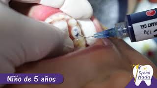 Curaciones dentales en dientes de leche [upl. by Nairrot929]