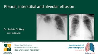 Fundamentals of Chest Radiography  Lesson 6 [upl. by Anaujait]