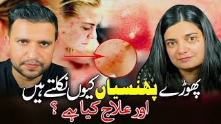 PimplesPhorrun Ka ilaj  Treatment of Boils  The Medbros  DrShoaib  Dr Hera [upl. by Eetsim703]