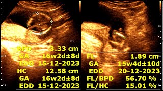 16 weeks 2 days pregnancy  Normal pregnancy [upl. by Yrak]