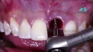 Implante imediato em área estética  Immediate implant in the esthetic zone  Full HD [upl. by Assenal]