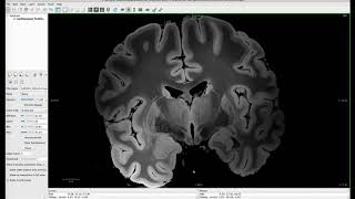 Tour the Subcortical Structures of the Brain using Freeview [upl. by Morey]