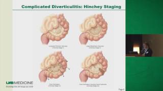 Diverticulitis To Operate or Not [upl. by Saundra]