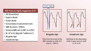 Advanced EKGs  Distinguishing VT from SVT with aberrancy [upl. by Emmalynne910]