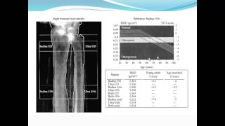 Bariatric Osteomalacia Fiona Cook MD  Internal Medicine Grand Rounds [upl. by Alasdair]