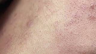 Acne on skin  Remove nose pimples  Acne Treatments Mai Ngoc 💕💕💕 [upl. by Eilatan521]