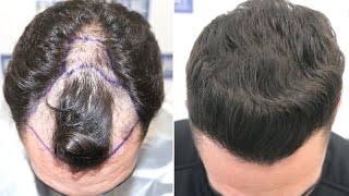 FUE Hair Transplant 1584 Grafts NW III A By Dr Juan Couto  FUEXPERT CLINIC Madrid Spain [upl. by Aierdna838]