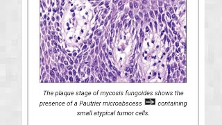 mycosis fungosis [upl. by Jerald]