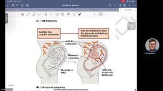 Rh Blood Group System and Haemolytic Diseases of Newborn [upl. by Atinas]