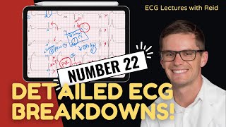 EKG Test Yourself  ECG Case Study 22 [upl. by Narrad]