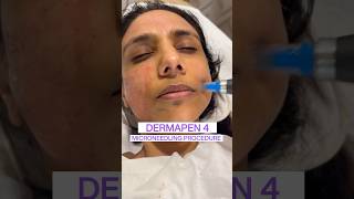 Dermapen microneedling  Eevara Clinic Noida  For appointments 📞 at 7024110785 [upl. by Emlyn512]