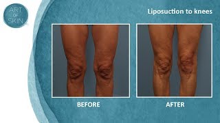 Lipo of knees [upl. by Florinda512]