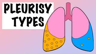 DIFFERENCES BETWEEN EXUDATIVE AND TRANSUDATIVE PLEURAL EFFUSION [upl. by Millar]