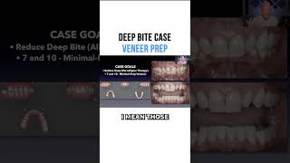 Deep Bite Case Veneer Prep [upl. by Knorring]