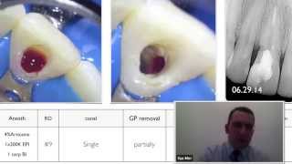 Cervical Root Resorption Repair Dr Ilya Mer Interview [upl. by Graniela518]