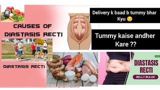 Diastasis Recti Delivery k baad b tummy bhar hai kyu janiye viralvideo medical knowledge [upl. by Eeliah790]