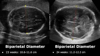 Fetal Biparietal Diameter Ultrasound Normal Values  BPD Measurements  Biometric Parameters USG [upl. by Atem]