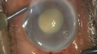 Surgical management of phacomorphic glaucoma with zonular weakness [upl. by Houston803]