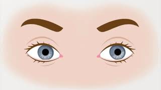 Animation of Left Upbeating Torsional Nystagmus seen in BPPV [upl. by Jaela]