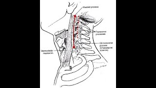 Tubercle of chassaignac or the Carotid tubercle of the 6th cervical vertebrae and its clinical relev [upl. by Meingolda]