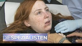 Pfusch bei AkneBehandlung Gesicht total geschwollen  Auf Streife  Die Spezialisten  SAT1 TV [upl. by Yreva605]