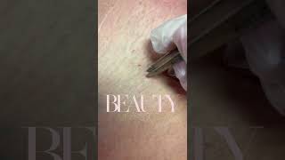 Ingrown Hair Removal [upl. by Dott358]