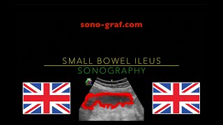 Sonography  Small Bowel Ileus [upl. by Angus]