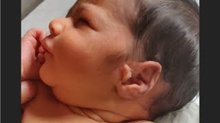 Bilateral Pre  auricular Tagbabyshorts babyvideos youtubeshorts medicalshorts medicalvideos [upl. by Vedette565]