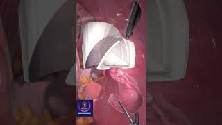 Laparoscopic Tissue Removal shorts medicalsurgery [upl. by Findlay200]