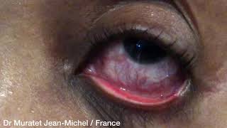 Filariose sousconjonctivale  Subconjunctival loiasis [upl. by Rheingold]